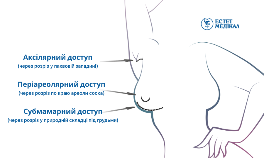 Хірургічні типи доступів для мамопластики